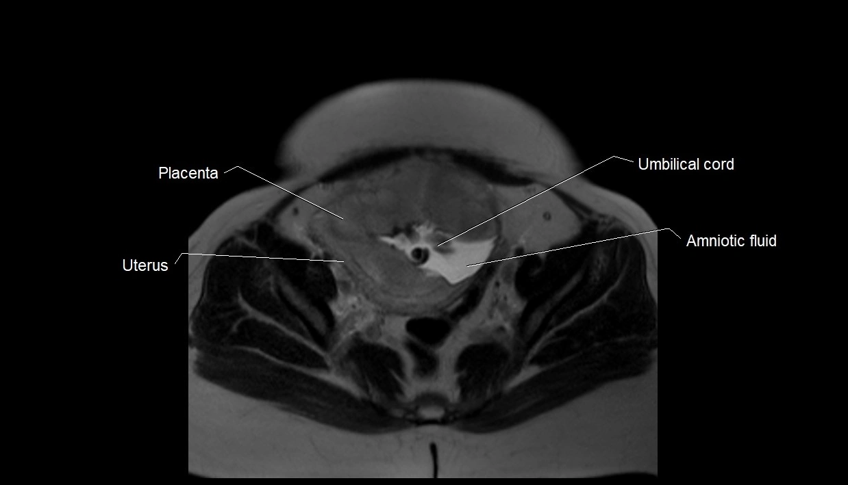 MRI fetal anatomy axial image 32.webp